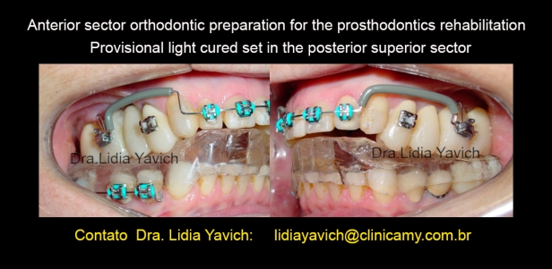 11 preparo ortodontico setor anterior